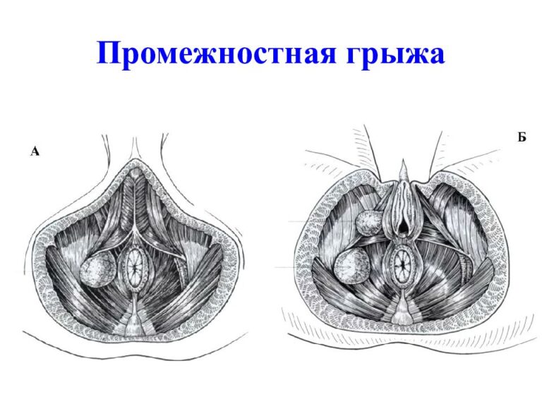 Бедренная грыжа фото