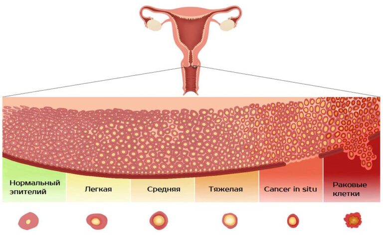 Болезни матки фото